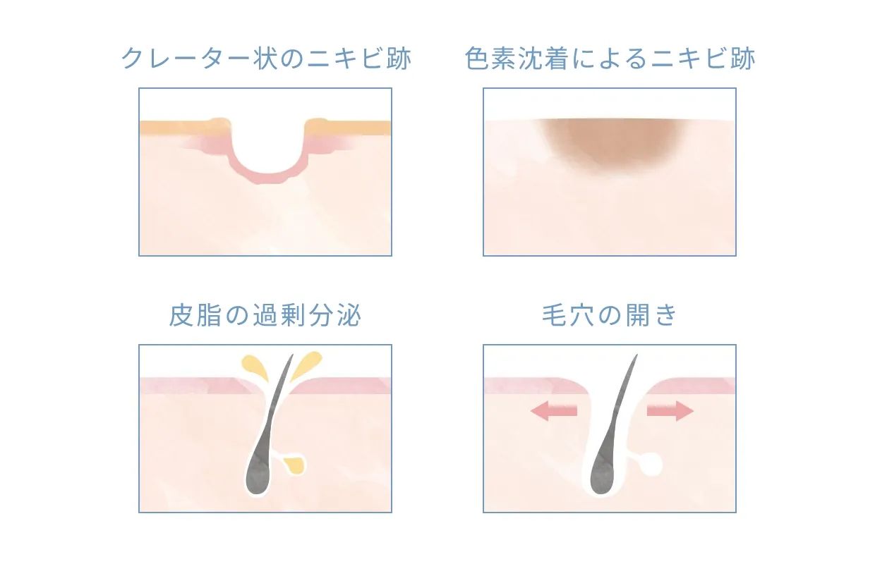 ニキビ跡をクリアに